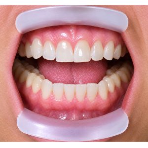 Lip Ring Retractor