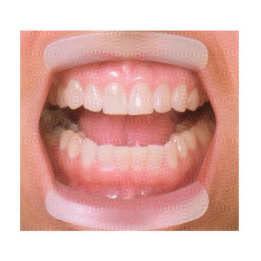 Lip Ring Retractor