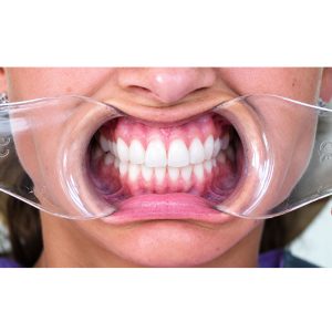 Alternative view of Autoclavable Clear Universal Occlusal Retractors