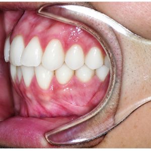 Alternative view of Autoclavable Clear Anterior & Posterior Photo Retractor