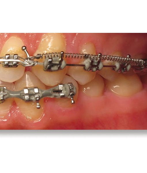 Nickel Titanium Closed Coil Springs Orthodontic Supply & Equipment