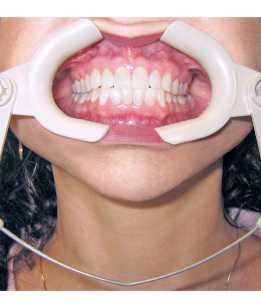 Adjustable Cheek Retractor Orthodontic Supply & Equipment Company