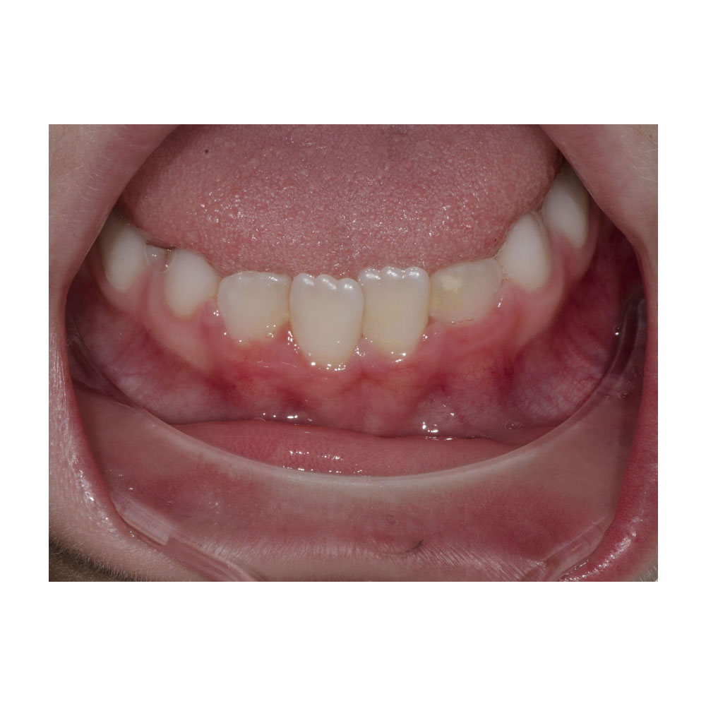 Angled Occlusal Retractor - Summit Orthodontic Services