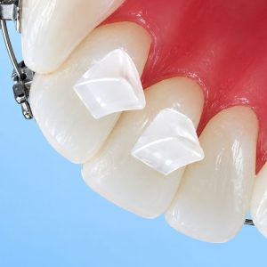 Alternative view of Bite Builder Orthodontic Bite Opener