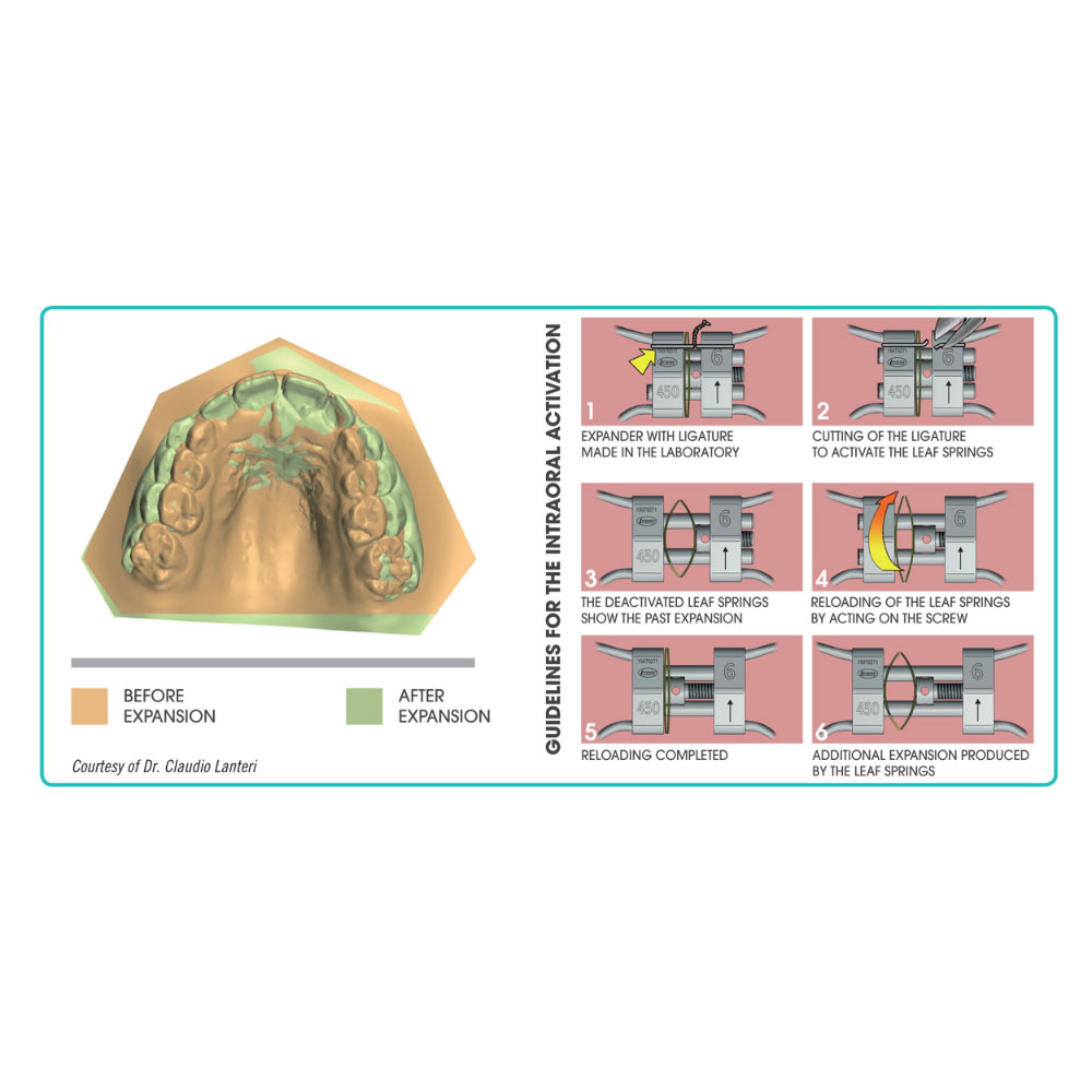Memoria Leaf Spring Activated Expander Orthodontic Supply & Equipment